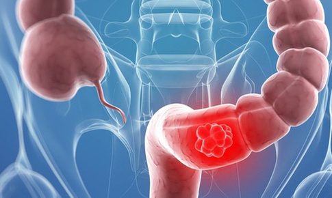 S&#224;ng lọc ph&#225;t hiện sớm ung thư đại tr&#224;ng