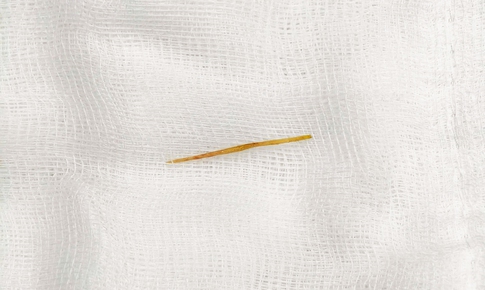 Thủng ruột do thói quen rất nhiều người mắc