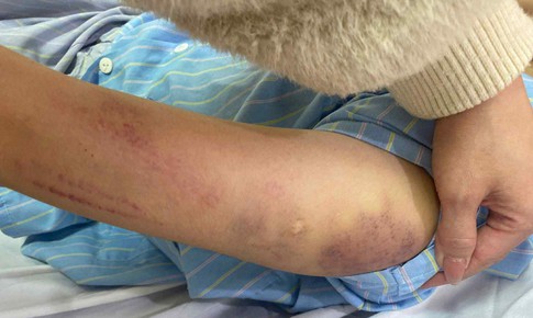 Nữ sinh lớp 7 ở Nghệ An nghi bị bố đánh bầm tím khắp người