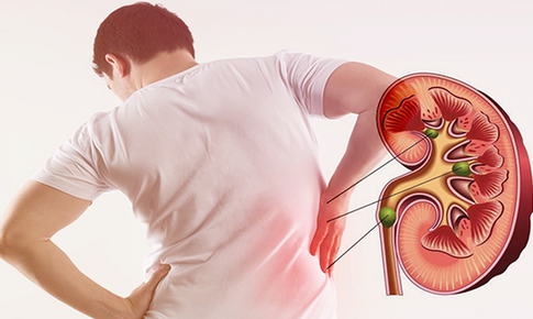 7 tác nhân âm thầm gây tổn thương thận không nên bỏ qua