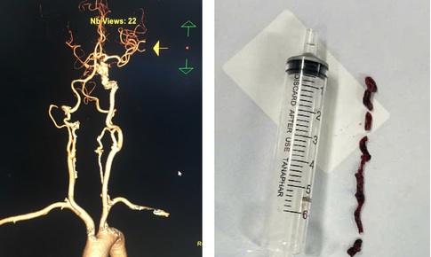 Cứu cụ bà 75 tuổi đột quỵ nhồi máu não thoát lằn ranh sinh tử