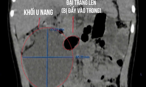 Cháu bé 26 tháng tuổi mắc khối u nang lớn, hiếm gặp, chèn ép gần một nửa vùng bụng phải