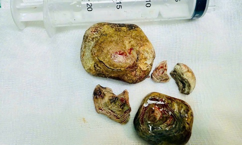 Phẫu thuật khối sỏi bàng quang kích thước lớn cho bệnh nhân mắc nhiều bệnh lý nền