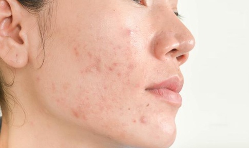 Top gel ngừa mụn được nhiều người lựa chọn trong năm 2025