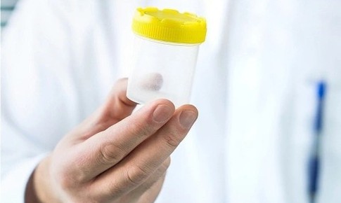 Tinh dịch đổi màu: Dấu hiệu bệnh lý không thể chủ quan