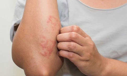 Viêm da cơ địa dễ tái phát khi thời tiết thay đổi