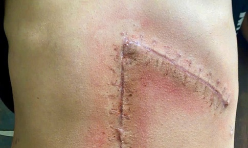 Cứu sống thiếu ni&#234;n sốc mất m&#225;u do vỡ l&#225;ch độ 5 sau tai nạn giao th&#244;ng