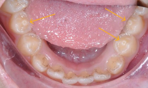 Răng c&#243; n&#250;m phụ – nguy cơ biến chứng nếu kh&#244;ng điều trị kịp thời
