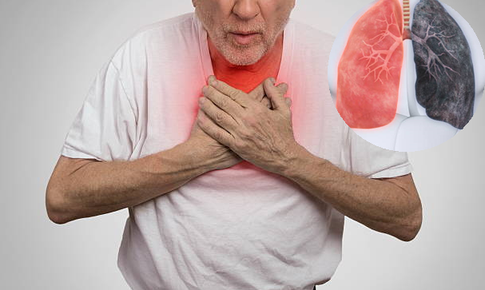 Người mắc phổi tắc nghẽn mạn t&#237;nh cần l&#224;m g&#236; khi &#244; nhiễm kh&#244;ng kh&#237; gia tăng?