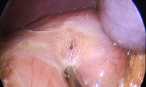 Phẫu thuật cấp cứu bệnh nhi 13 tuổi bị thủng ổ lo&#233;t dạ d&#224;y – t&#225; tr&#224;ng v&#224; lời cảnh tỉnh từ b&#225;c sĩ