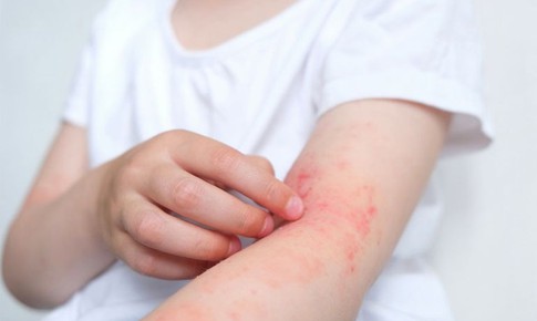 Dị ứng mạt bụi nh&#224; ảnh hưởng tới sức khoẻ như thế n&#224;o?