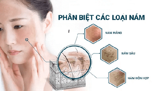 L&#224;m sao để kh&#244;ng bị t&#225;i n&#225;m da sau điều trị?