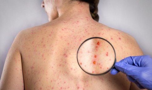 Thai nhi bị ảnh hưởng thế n&#224;o nếu người mẹ nhiễm rubella?