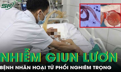 2 bệnh nh&#226;n nhiễm giun lươn g&#226;y hoại tử phổi nghi&#234;m trọng