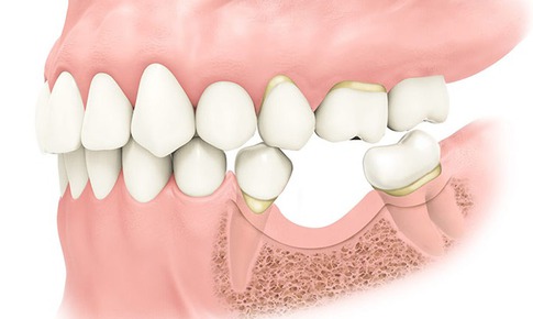 Ai cần gh&#233;p xương trong cấy gh&#233;p implant?