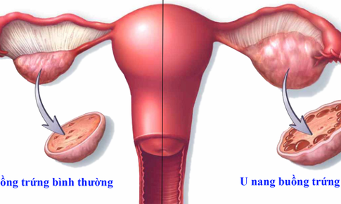 Phụ nữ cần đi kh&#225;m phụ khoa định kỳ để ph&#225;t hiện căn bệnh nguy hiểm, &#237;t triệu chứng n&#224;y