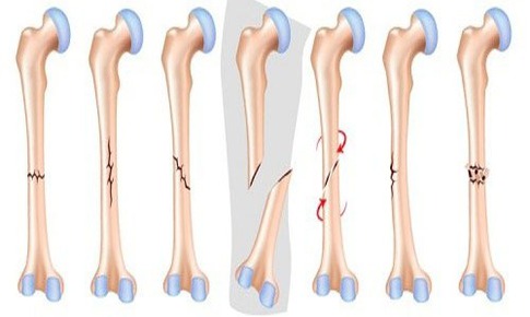 Gãy xương: Nguyên nhân, triệu chứng, cách phòng tránh và điều trị