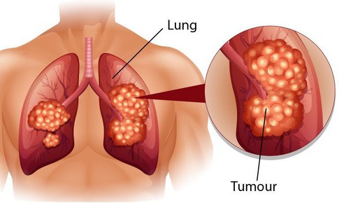 Ung thư phế quản phổi nguy&#234;n ph&#225;t: Nguy&#234;n nh&#226;n, triệu chứng, c&#225;ch điều trị v&#224; ph&#242;ng bệnh