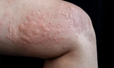 Cách trị nổi mề đay, giảm ngứa rát tại nhà hiệu quả