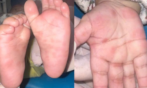 Nốt đỏ lòng bàn tay hé lộ căn bệnh nguy hiểm ở bé 4 tháng tuổi