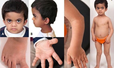 Câu hỏi thường gặp liên quan đến loạn sản sụn xương