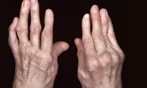 Các thuốc trị viêm khớp dạng thấp