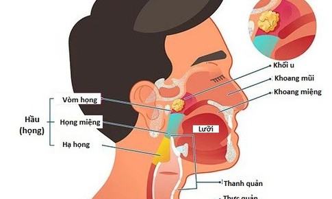Ung thư đầu và cổ - Những điều nên biết