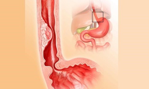 Câu hỏi thường gặp liên quan đến bệnh hẹp thực quản