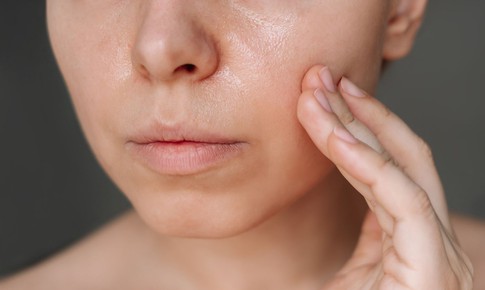 Da dầu có cần dùng kem dưỡng ẩm vào mùa hè không?