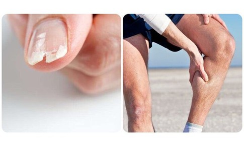 8 dấu hiệu cảnh báo cơ thể thiếu canxi cần bổ sung ngay