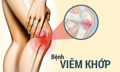 Viêm khớp: Nguyên nhân, triệu chứng, cách điều trị và phòng ngừa