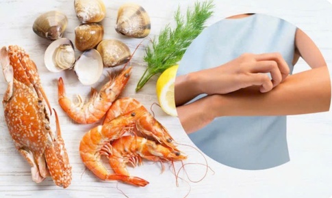 Đi du lịch biển, cần chú ý 6 loại hải sản dễ gây dị ứng nhất