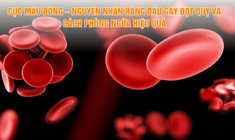 Cục máu đông – Nguyên nhân và cách phòng ngừa hiệu quả