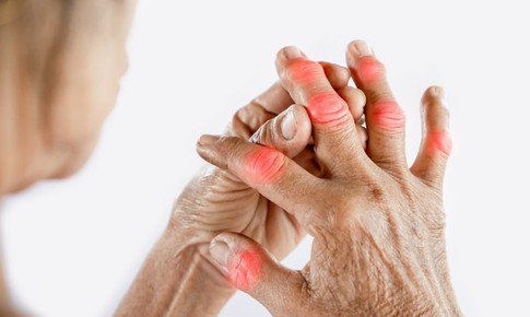 Biểu hiện cảnh báo khởi phát bệnh gút