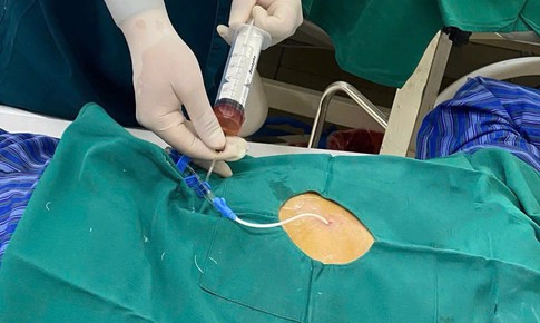 Cứu sống cụ ông tràn dịch màng ngoài tim do lao biến chứng