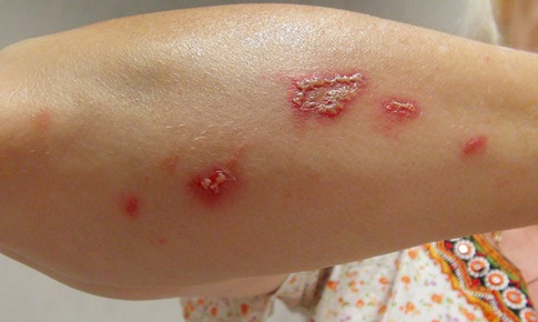 Mùa hè cảnh giác với bệnh da do côn trùng