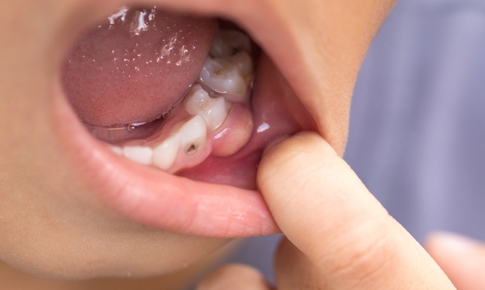 Đừng chủ quan với sưng mộng răng, nhiều người đã phải nhập viện vì bỏ qua dấu hiệu này