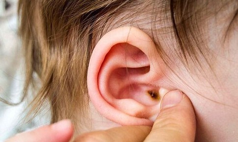 Biến chứng viêm tai giữa ở trẻ nguy hiểm hơn bạn tưởng