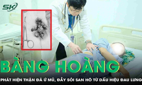 Đau lưng nhưng chủ quan, người phụ nữ không ngờ thận đã ứ mủ, đầy sỏi san hô