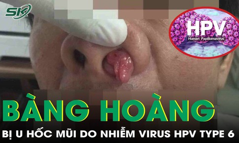 Người đàn ông bị u hốc mũi do nhiễm virus HPV type 6