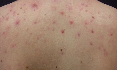 Nóng gan gây nổi mụn lưng?