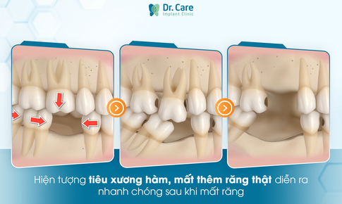 Trồng Implant toàn hàm: hy vọng cho người mất răng lâu năm, tiêu xương!