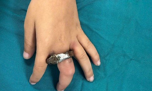 Vòng khóa siết ngón tay bé trai, gia đình cưa cửa mang đến viện