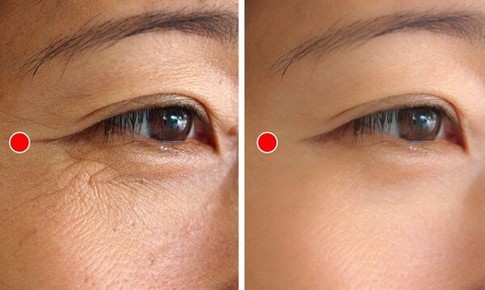 5 động tác đơn giản hằng ngày xóa mờ nếp nhăn đuôi mắt