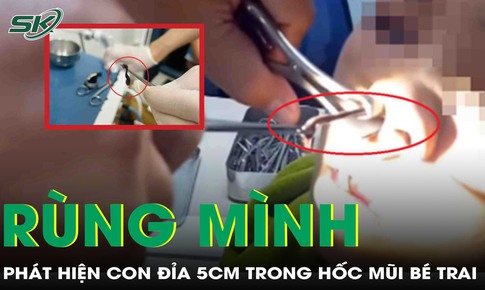 Đi khám vì chảy máu mũi, bé trai khiến bác sĩ rùng mình khi gắp ra “dị vật”