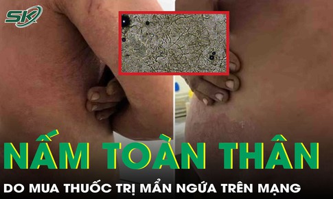 Tự ý mua thuốc trên mạng điều trị mẩn ngứa, người đàn ông bị nấm toàn thân