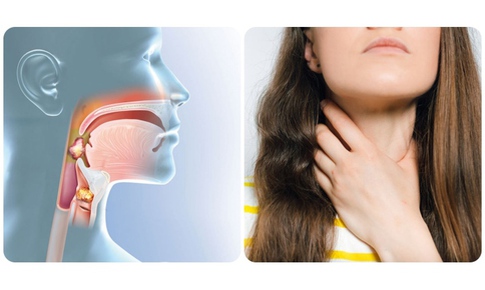 Biểu hiện cảnh b&#225;o ung thư v&#242;m họng giai đoạn đầu