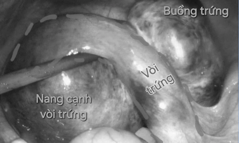 Bệnh viện tuyến quận cấp cứu thành công hai ca xoắn cơ quan sinh dục nguy hiểm