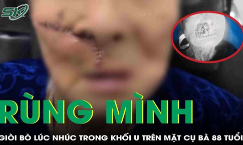Rùng mình: Giòi bò lúc nhúc trong khối u trên mặt cụ bà 88 tuổi ở Quảng Nam