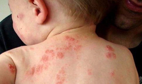 Trẻ bị viêm da dị ứng khi nào cần gặp bác sĩ?